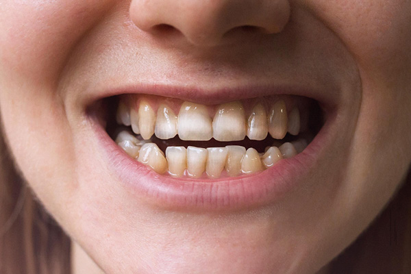 Men răng có thể bị hư do kem đánh răng than hoạt tính